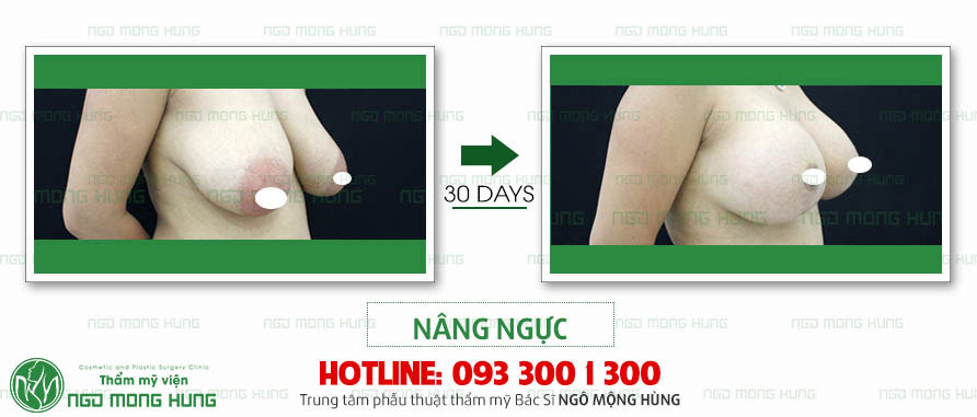 Hình ảnh nâng ngực bằng Silicon