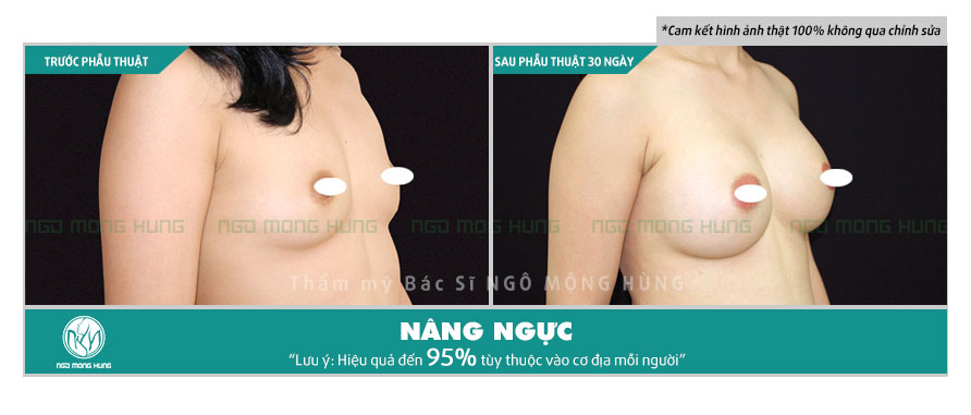 Hình ảnh nâng ngực bằng Silicon
