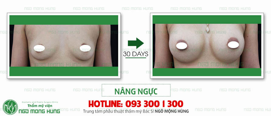 Ảnh ngực chảy xệ