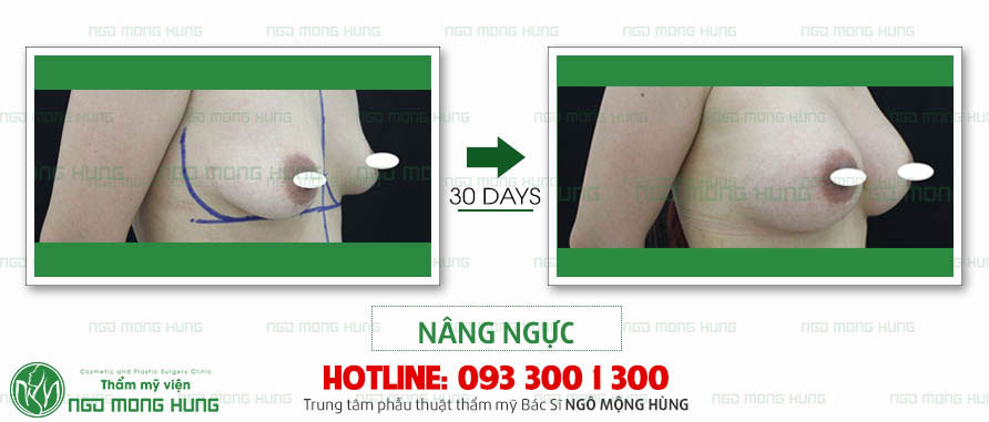 Ảnh ngực chảy xệ