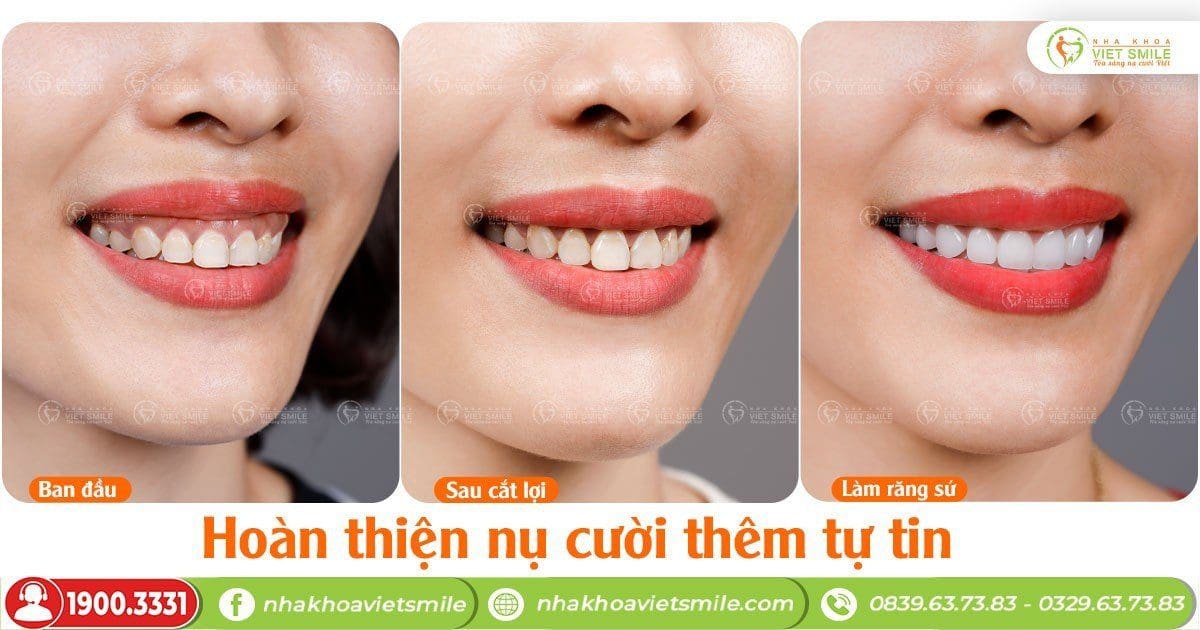Cắt lợi và bọc răng sứ cho nụ cười hài hòa