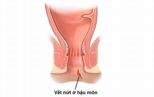 Hình ảnh mô phỏng tình trạng nứt kẽ hậu môn.