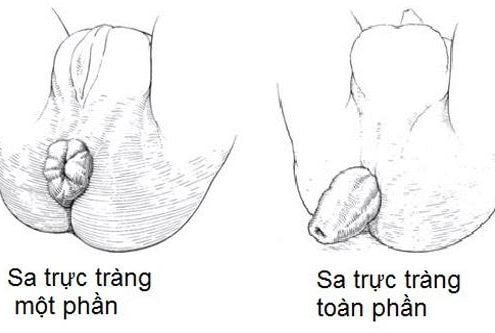 Một số trường hợp sa trực tràng cũng có thể dẫn đến tình trạng đi ngoài ra máu.