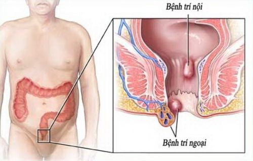 Đại tiện máu tươi: Nguyên nhân và cách điều trị