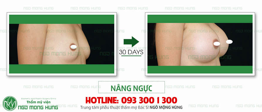 Bạn đã biết địa chỉ thẩm mỹ nâng ngực nào CHẤT LƯỢNG - UY TÍN cho mình chưa?
