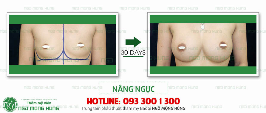Bạn đã biết địa chỉ thẩm mỹ nâng ngực nào CHẤT LƯỢNG - UY TÍN cho mình chưa?