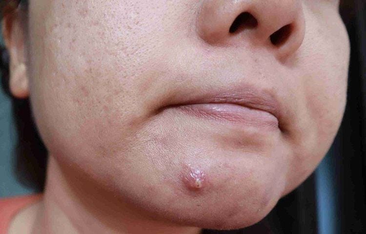 Việc nặn mụn không làm cho tình trạng tốt lên mà còn khiến chúng có nguy cơ sưng tấy, nổi đỏ