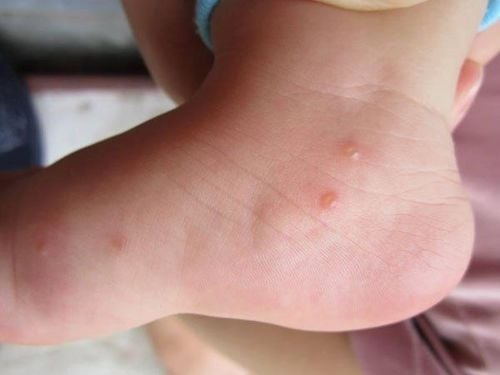 Những loại mụn không nên nặn
