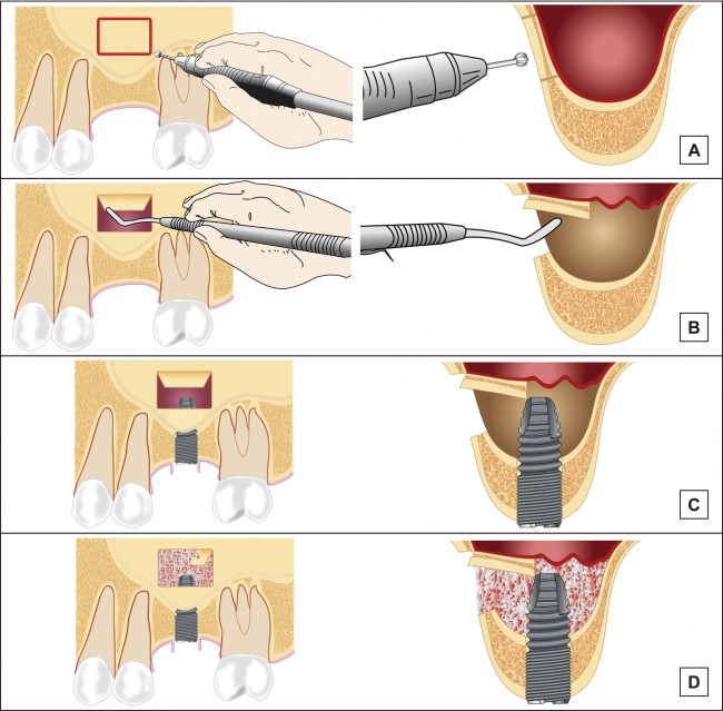 Nâng xoang là gì? Cấy ghép Implant nâng xoang khi nào?