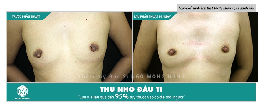 Thu nhỏ đầu vú