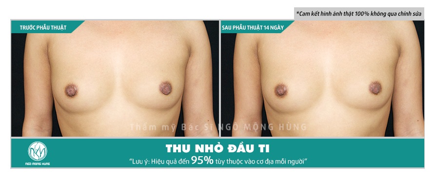 Thu nhỏ đầu vú