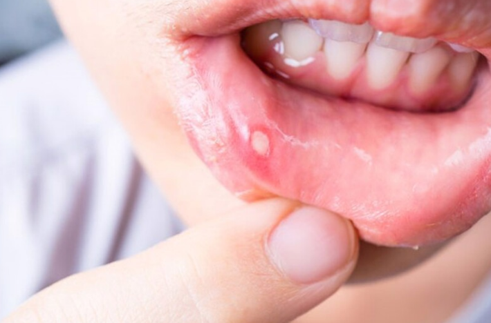 Trị nhiệt miệng bằng xát muối có thật sự hiệu nghiệm?