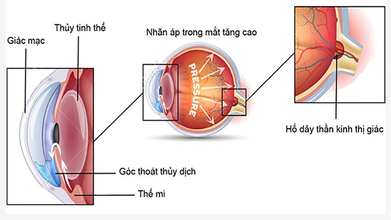 V.Rohto nhỏ nhiều sẽ gây tăng nhãn áp? Lưu ý khi dùng thuốc nhỏ mắt V.Rohto