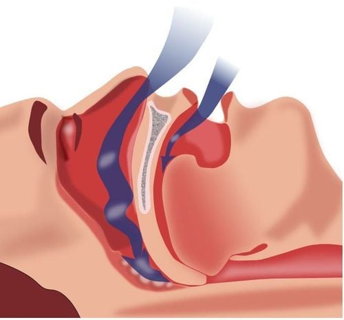 Hội chứng ngưng thở lúc ngủ và cách điều trị
