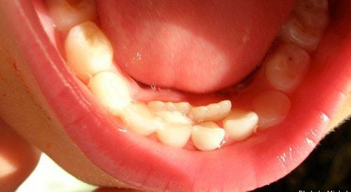 Răng vĩnh viễn mọc nhưng răng sữa chưa rụng dù đến tuổi thay răng