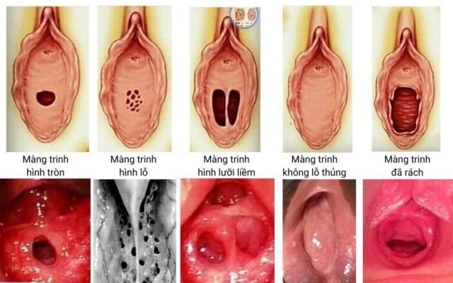 20+ Hình ảnh màng trinh thật con gái chưa rách và đã rách