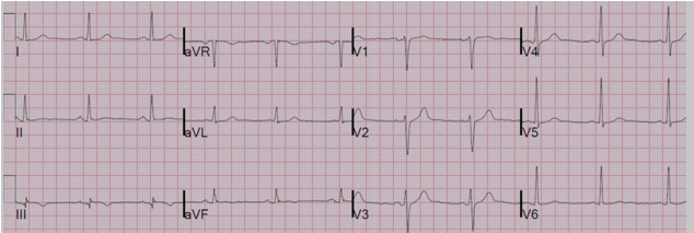 Nhồi máu cơ tim tương đương ST chênh lên: Hình ảnh không thể bỏ qua (St elevation myocardial infarction equivalents – Stemi equivalents: Can’t-miss patterns) – P2