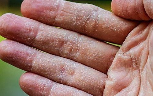 Cách xử lý khi bị tróc da tay