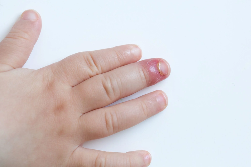 Trẻ bị xước măng rô là thiếu chất gì? Cách xử lý bố mẹ cần biết 2
