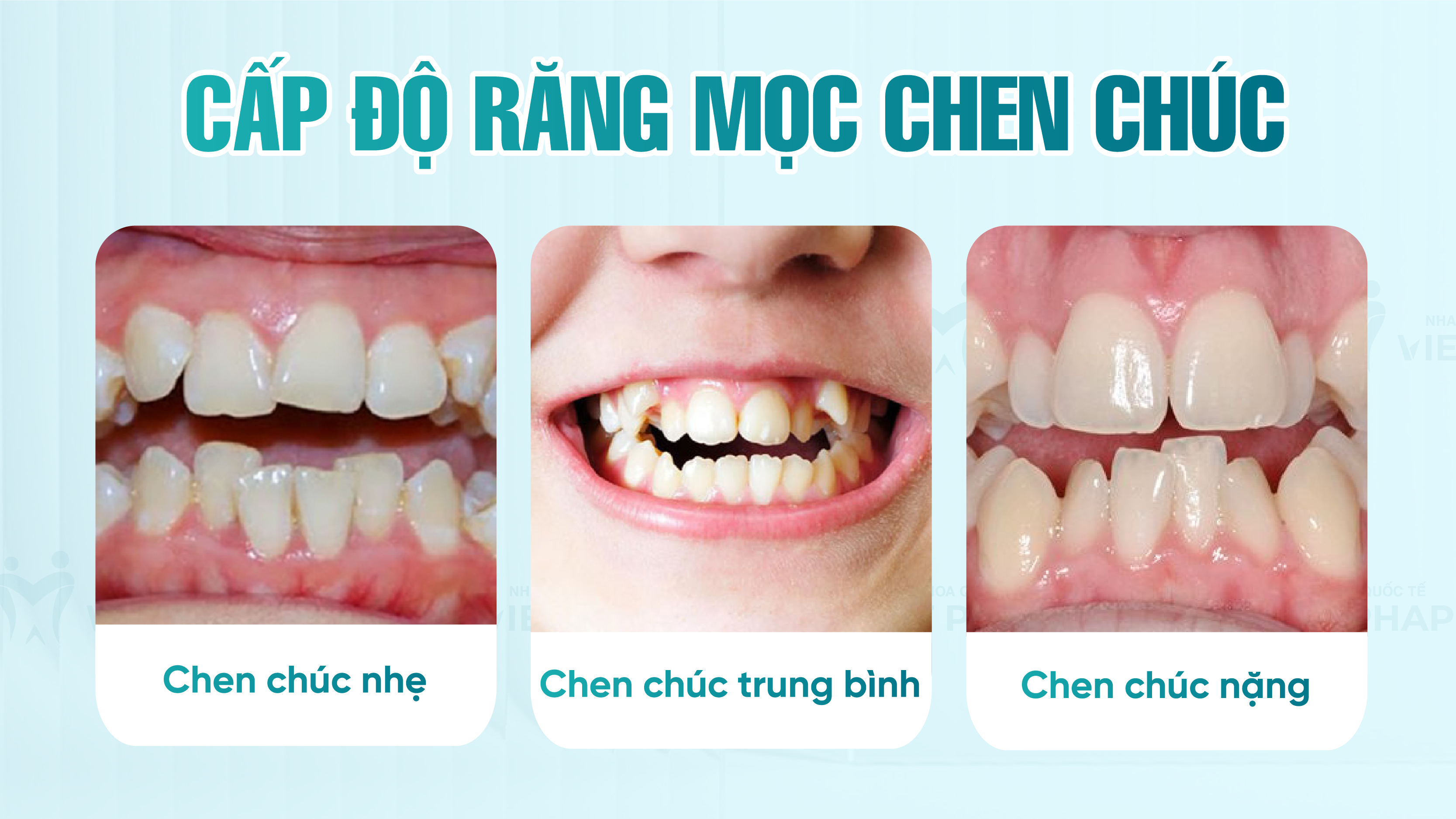 Cấp độ răng mọc chen chúc