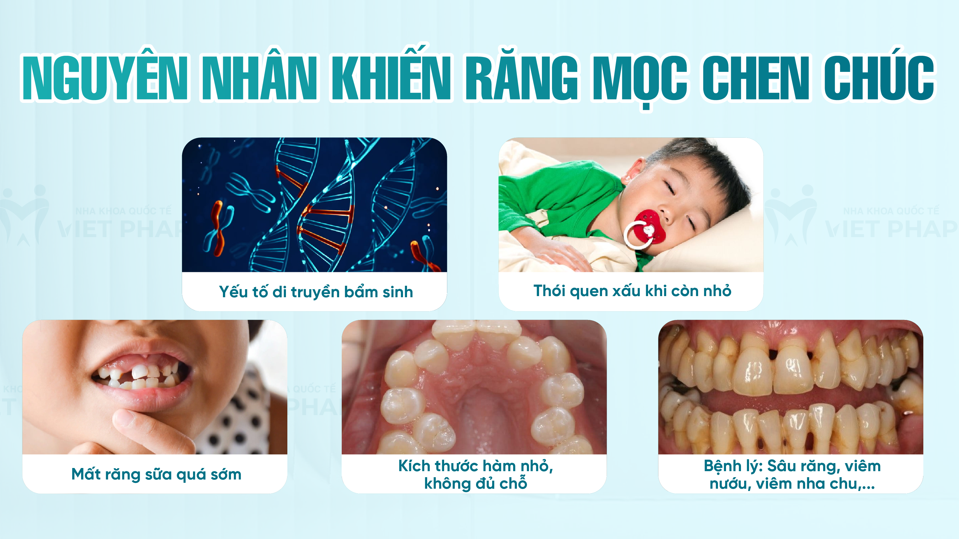 Nguyên nhân khiến răng mọc chen chúc