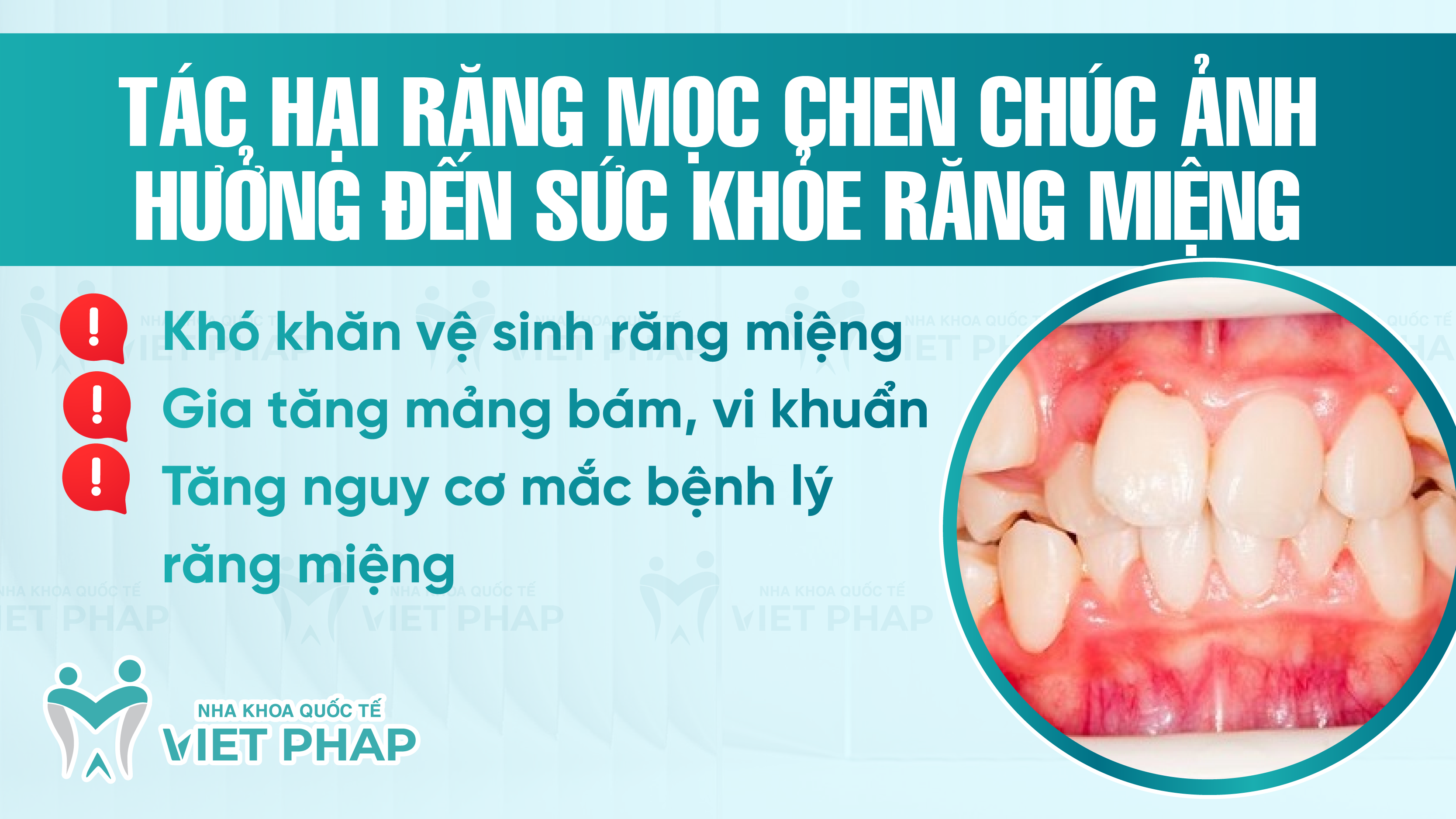 Tác hại răng mọc chen chúc ảnh hưởng đến sức khỏe răng miệng