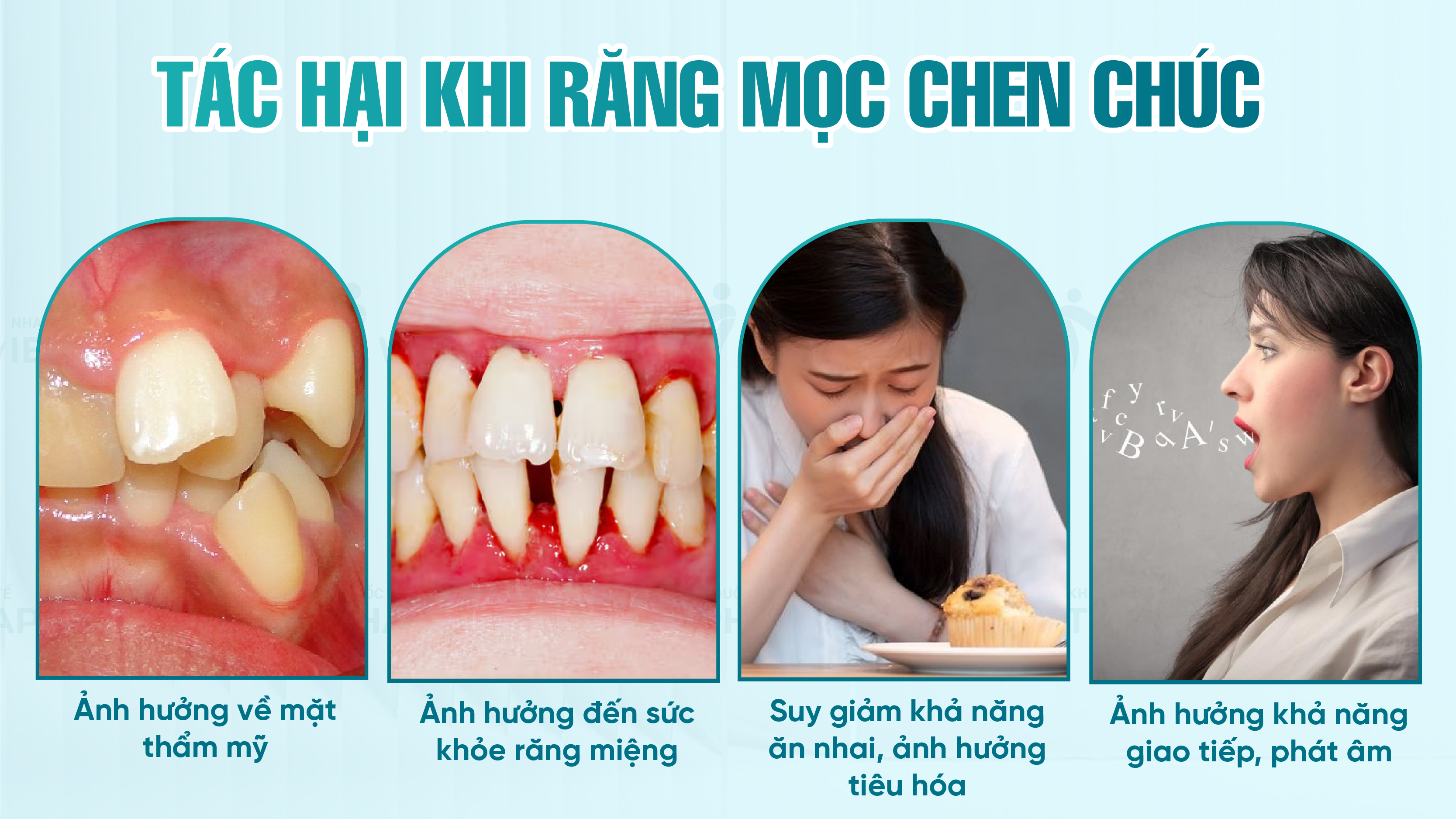Tác hại khi răng mọc chen chúc