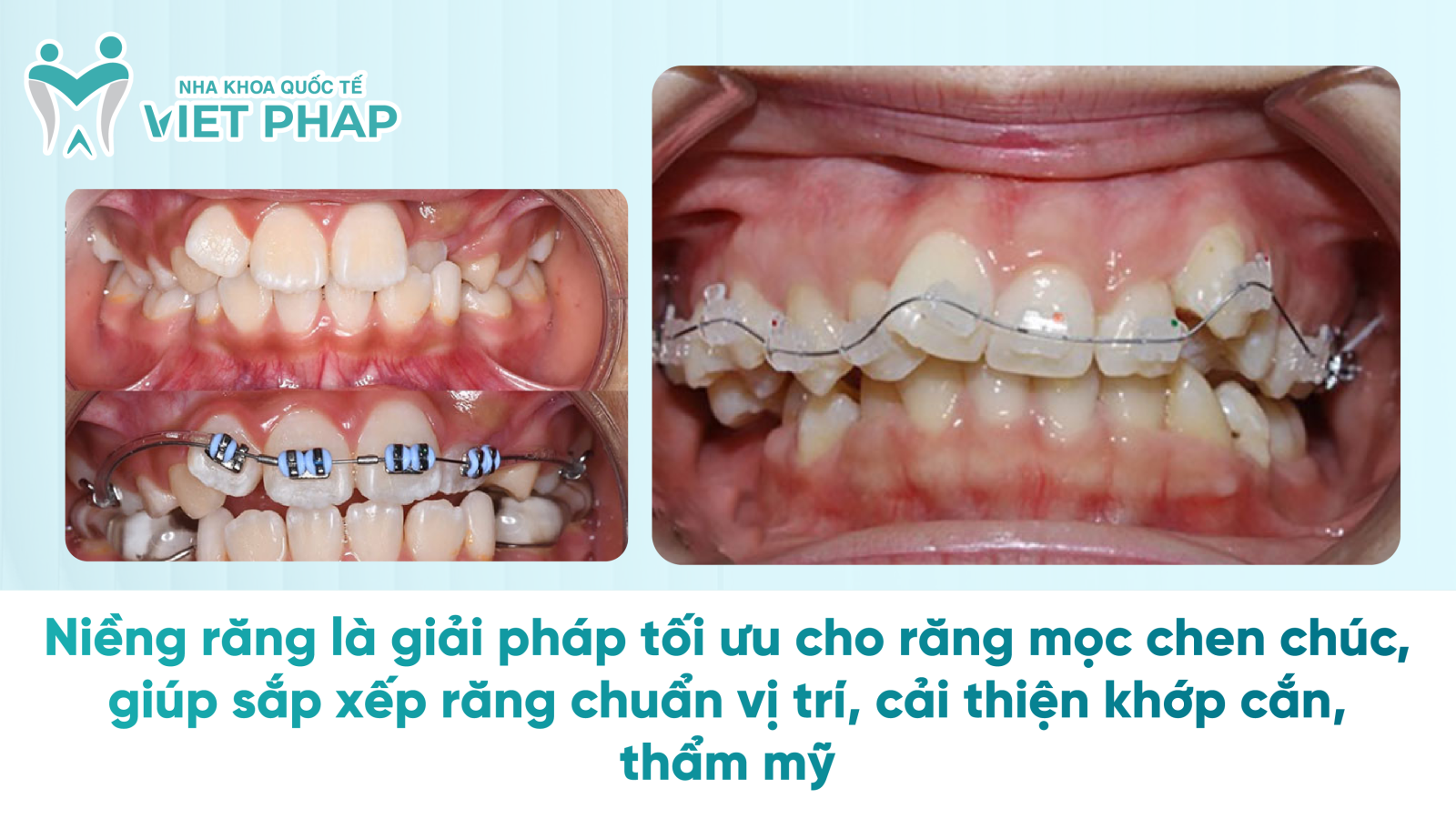 Niềng răng là giải pháp tối ưu cho răng mọc chen chúc, giúp sắp xếp răng chuẩn vị trí, cải thiện khớp cắn, thẩm mỹ