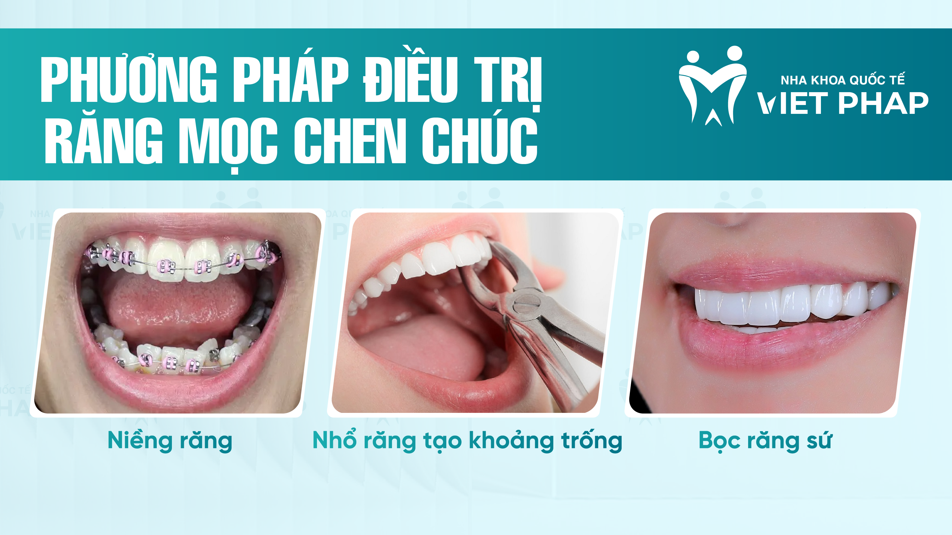 Phương pháp điều trị răng mọc chen chúc