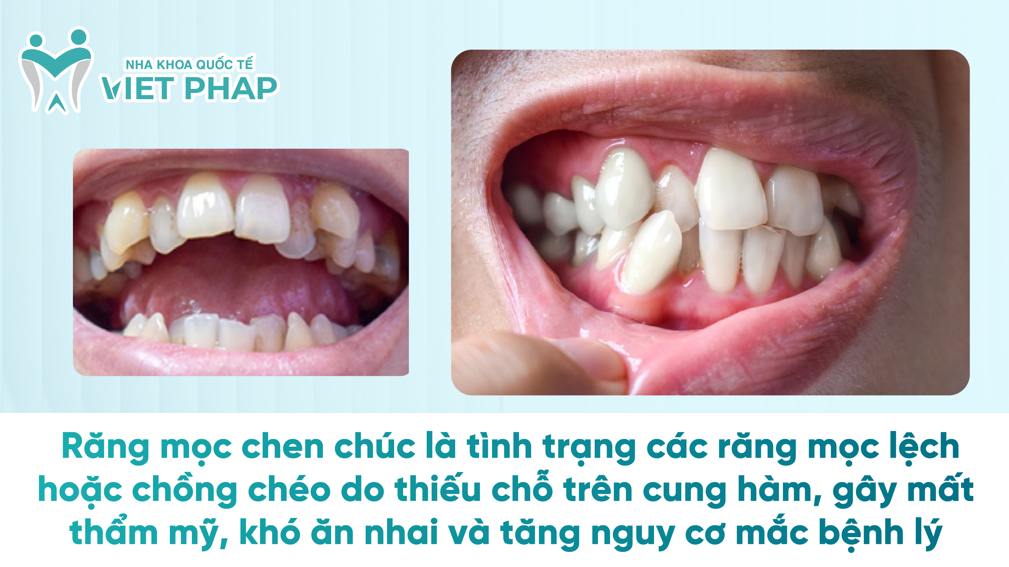 Răng mọc chen chúc là tình trạng các răng thiếu chỗ trên cung hàm, mọc lệch hoặc chồng chéo, gây mất thẩm mỹ, khó ăn nhai, làm tăng nguy cơ bệnh răng miệng