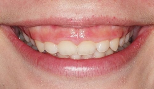 Nhân tướng học nhận định con gái cười hở lợi thì sao?