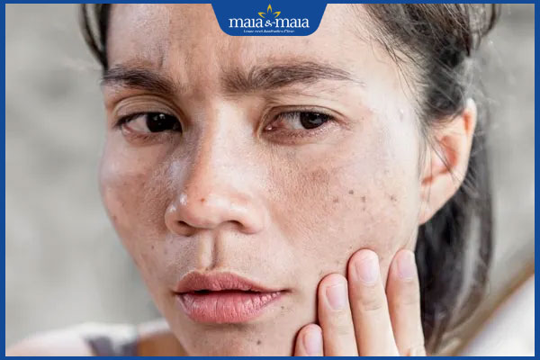 Đốm đen trên da có nguy hiểm không? Cách chẩn đoán và điều trị