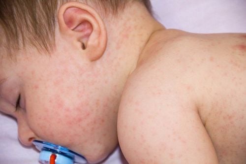 Rôm sảy nếu không được điều trị kịp thời có thể vỡ gây nhiễm trùng da, viêm da, để lại sẹo.