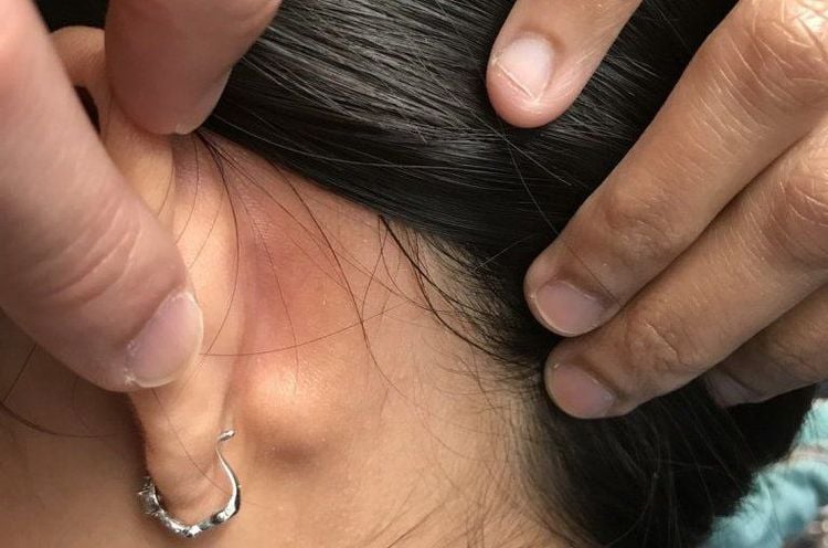 Nổi hạch sau tai có thể là biểu hiên của u nang bã nhờn