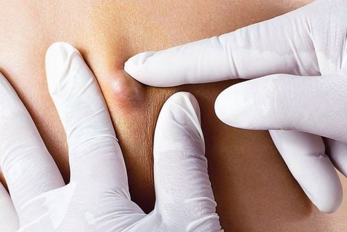 Nổi hạch sau tai có đáng lo?