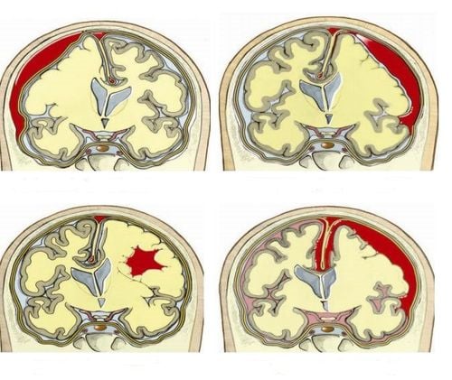 Một số dạng chấn thương sọ não thường gặp