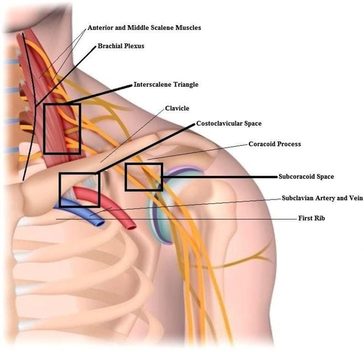 Hình ảnh hội chứng lối ra lồng ngực (Thoracic outlet syndrome)
