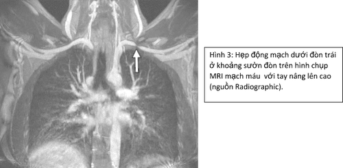 Hình 3: Hẹp động mạch dưới đòn trái ở khoảng sườn đòn trên hình chụp MRI mạch máu với tay nâng lên cao (Nguồn: Radiographic)