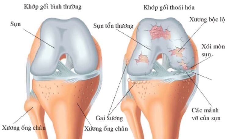 Tổn thương thoái hóa khớp