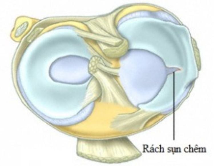 Rách sụn chêm ngoài