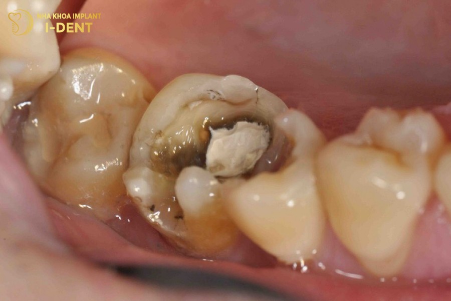 Răng Bị Sâu Lỗ To Có Trám Được Không?