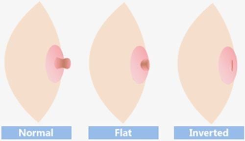 Cách chữa núm vú bị tụt đơn giản và hiệu quả