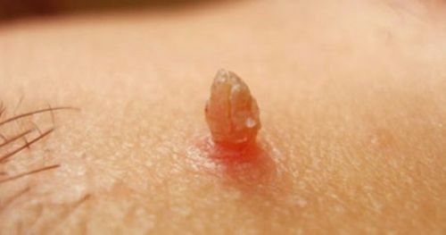 U nhú là một trong các loại u biểu mô lành tính của các tế bào biểu mô phủ