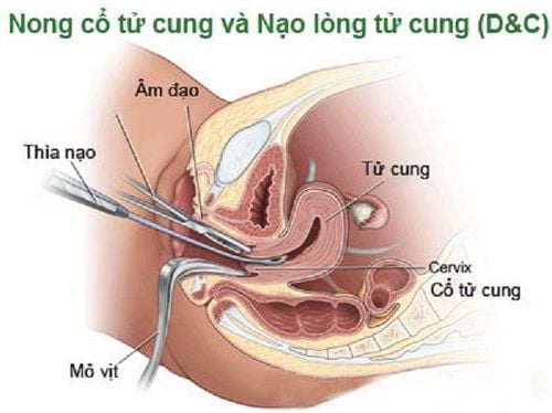 Nong nạo cổ tử cung để loại bỏ được hết nhau thai