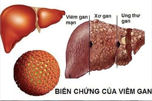 Các trường hợp có dấu hiệu của viêm gan nếu không được điều trị có thể gây suy giảm chức năng.