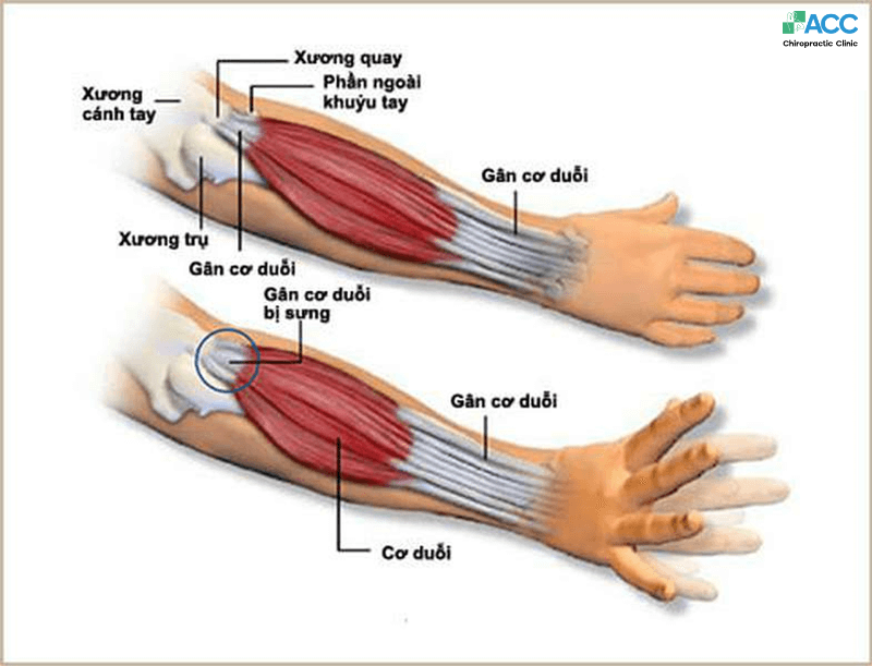 Đau khuỷu tay: 
Nguyên nhân, triệu chứng và cách điều trị