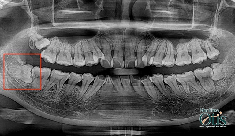 Răng khôn mọc lợi trùm gây đau âm ỉ