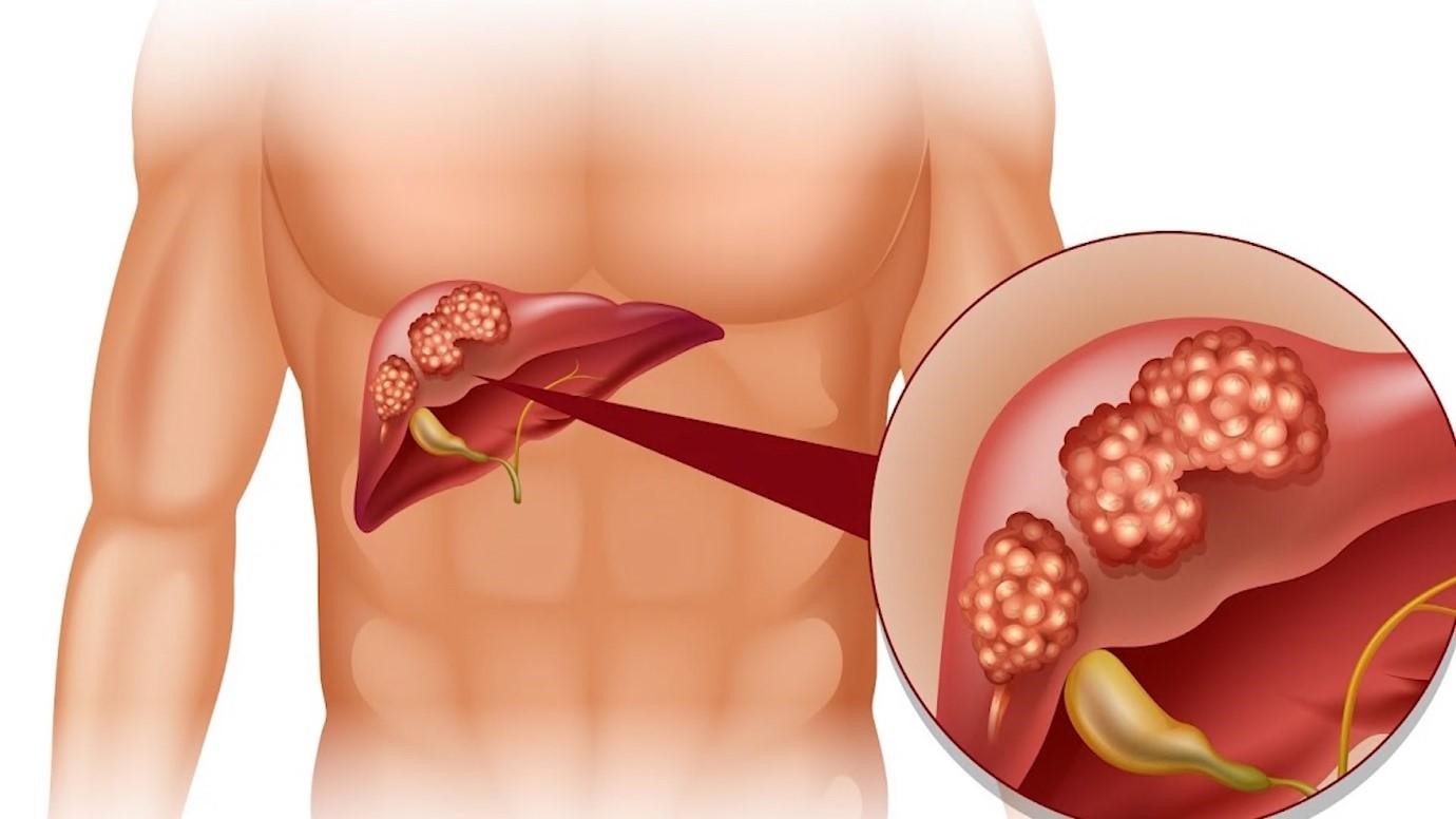 Giải đáp: Truyền nước biển có tác dụng gì? Những trường hợp không được truyền nước biển? 2