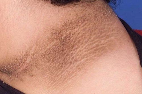 Người bệnh nên đến cơ sở y tế để được thăm khám và điều trị khi phát hiện bệnh gai đen