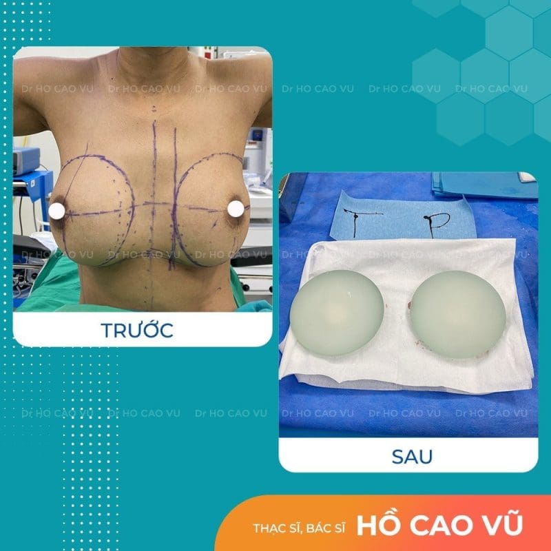 nguc bi thong khe 3